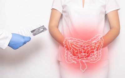 Diverticolosi del colon: sintomi, cause e quali cibi evitare